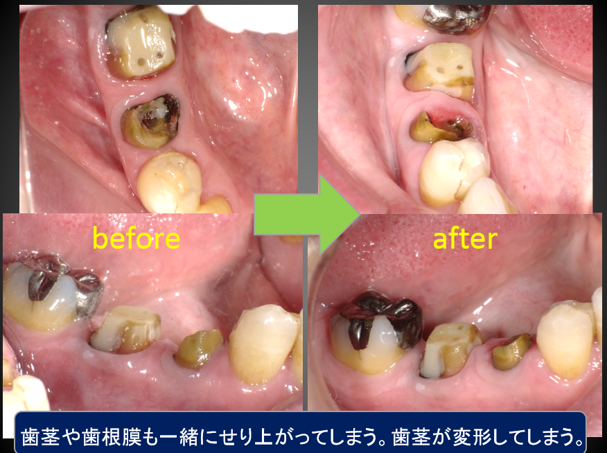 歯の延出状態写真