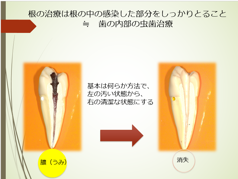 歯根端切除説明図１