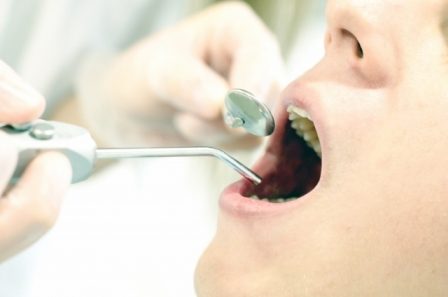 虫歯治療の診断と治療