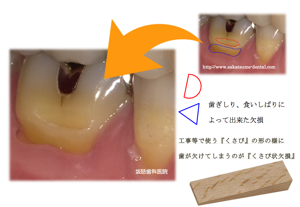 歯ぎしり・食いしばり・歯磨きによる歯の損傷