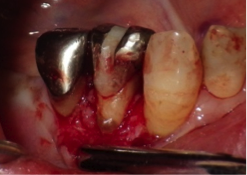フラップ手術歯石
