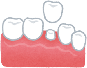 仮歯を入れたら注意すること！