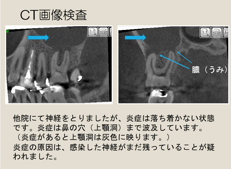 診断名：左側歯性上顎炎