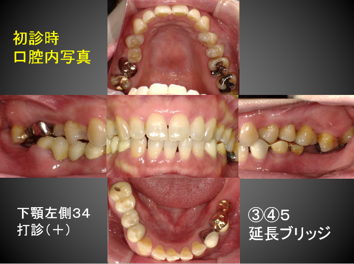 歯根端切除術　下顎左側２歯同時治療