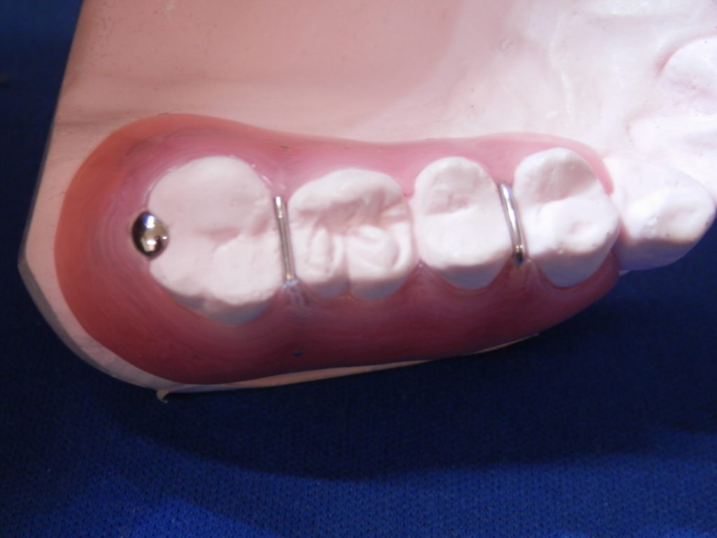 ペリオ義歯