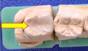 根管治療（根の治療）の位置づけ２