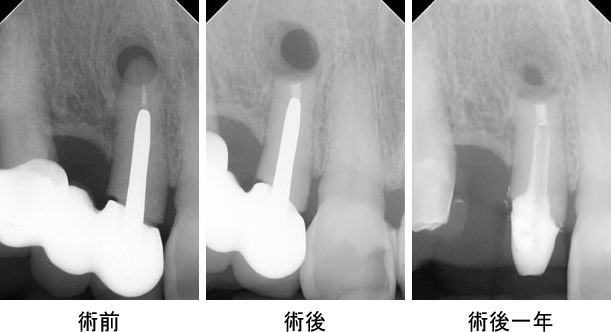 上顎右側２歯根端切除術