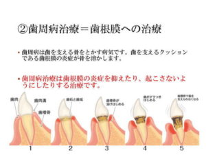 根管治療（根の治療・神経の治療）の流れ