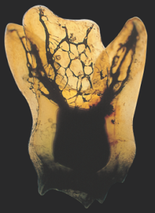 マイクロスコープを使った歯根端切除術