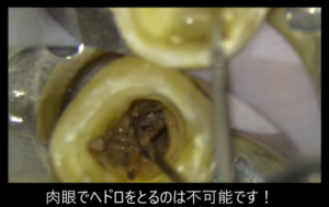 当院が考える根管治療後の歯を長持ちさせる２つ考え方