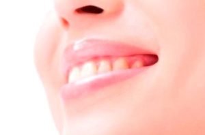 セルフホワイトニングは要注意？！～歯科医院で行うホワイトニングとの違い～