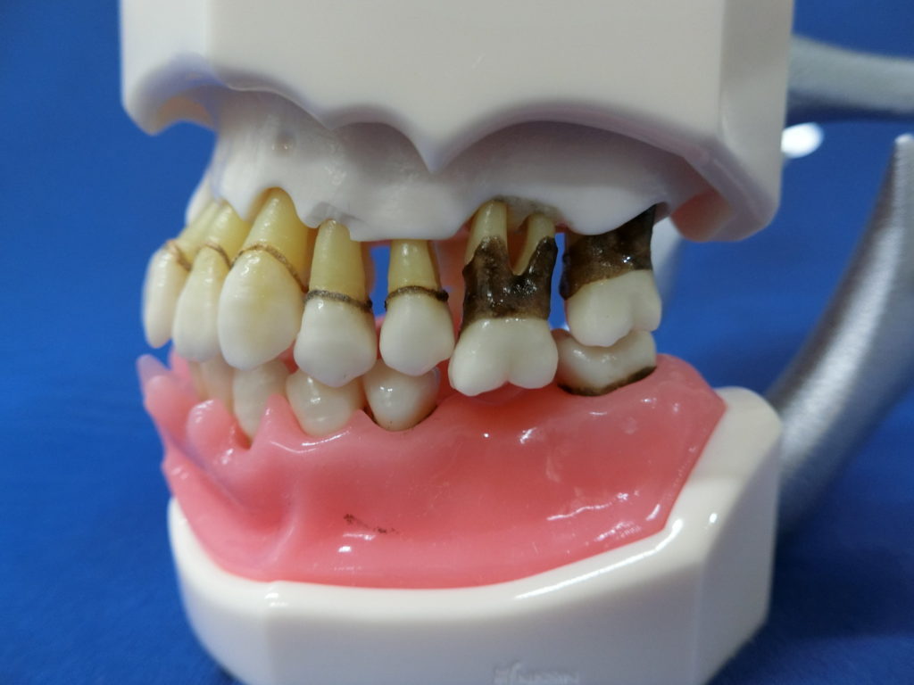 歯周病欠損モデル