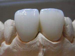 金属を使わない虫歯治療