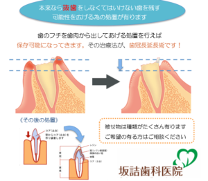 ＡＰＦ　　精密根管治療を可能にする治療