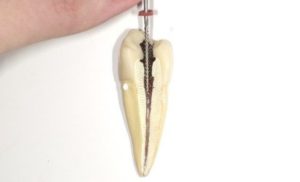 ニッケルチタンファイルと根管形成