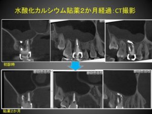 マイクロスコープを使った歯性上顎炎の治療