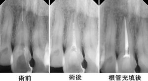 破折ファイル除去がからむ根管治療