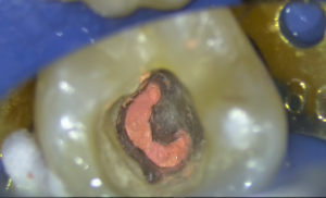 樋状根（といじょうこん）