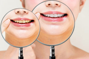 大人の虫歯の特徴 : 歯周病を伴った虫歯