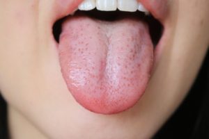 舌に歯の跡がついている！！～舌のふちをみてみよう～